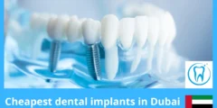 Cheapest dental implants in Dubai – Honest Price Guide & Best Low-Cost Clinics