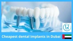 Cheapest dental implants in Dubai