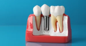 Dental Implants Cost in Dubai