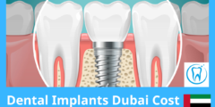 Dental Implants Dubai Cost – Updated Prices 2026