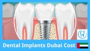 Dental Implants Dubai Cost – Updated Prices 2026