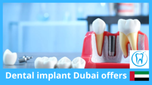 Dental implant Dubai offers by Clinic – Up to 60% Off