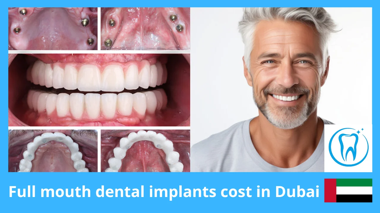 Full mouth dental implants cost in Dubai – Real Prices, Options & Clinic Examples