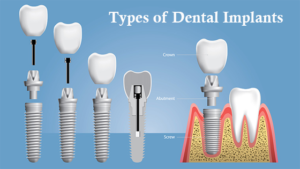 Types of Dental Implants in Dubai