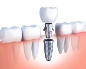 dental implants dubai